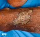 lichen planus