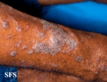 lichen planus