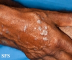 lichen planus