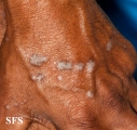 lichen planus