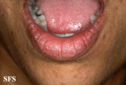 lichen planus