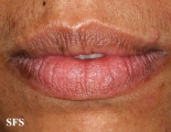 lichen planus