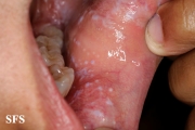 lichen planus