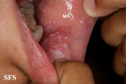 lichen planus