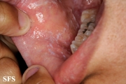 lichen planus