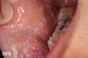 lichen planus