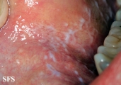 lichen planus