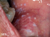 lichen planus
