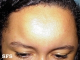 angioedema