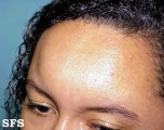 angioedema