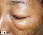angioedema