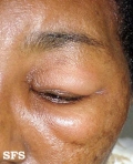 angioedema