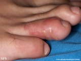 larva migrans