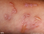 larva migrans