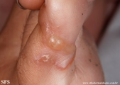 larva migrans
