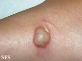 larva migrans
