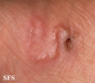 larva migrans