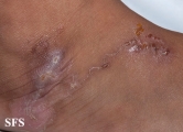 larva migrans