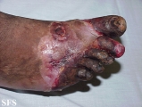 peripheral occlusive arterial disease
