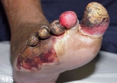 peripheral occlusive arterial disease
