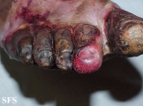 peripheral occlusive arterial disease
