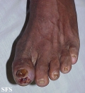 peripheral occlusive arterial disease