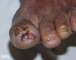 peripheral occlusive arterial disease