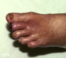 peripheral occlusive arterial disease