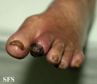 peripheral occlusive arterial disease
