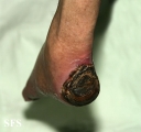 peripheral occlusive arterial disease