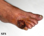 peripheral occlusive arterial disease