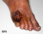 peripheral occlusive arterial disease