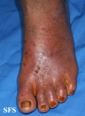 peripheral occlusive arterial disease