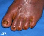 peripheral occlusive arterial disease