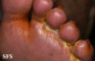peripheral occlusive arterial disease