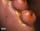 peripheral occlusive arterial disease