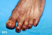 peripheral occlusive arterial disease