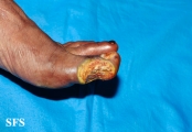 peripheral occlusive arterial disease