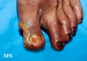 peripheral occlusive arterial disease