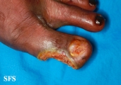 peripheral occlusive arterial disease