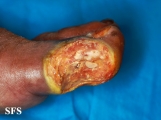 peripheral occlusive arterial disease