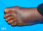 peripheral occlusive arterial disease
