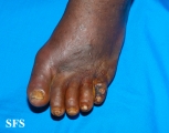 peripheral occlusive arterial disease