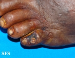 peripheral occlusive arterial disease