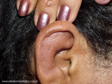 Relapsing Polychondritis