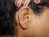 Relapsing Polychondritis
