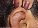 Relapsing Polychondritis