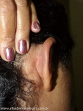 Relapsing Polychondritis