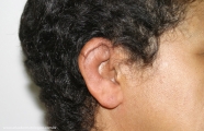 Relapsing Polychondritis