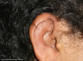 Relapsing Polychondritis
